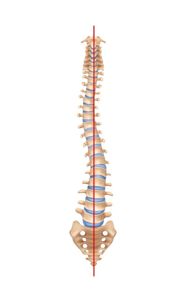 Scoliosis