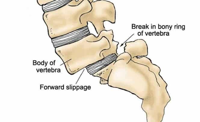 Spondylolisthesis - Vertebral Slippage Illustration