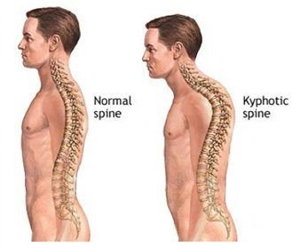 Kyphosis Correction Surgery - Normal vs Kyphotic Spine